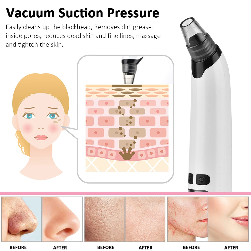 Facial Deep Pore Blackhead Remover - MybeautySync