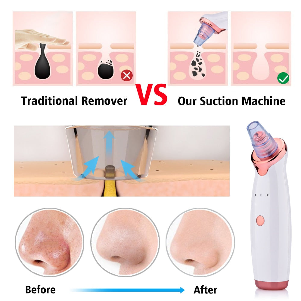 Facial Deep Pore Blackhead Remover - MybeautySync