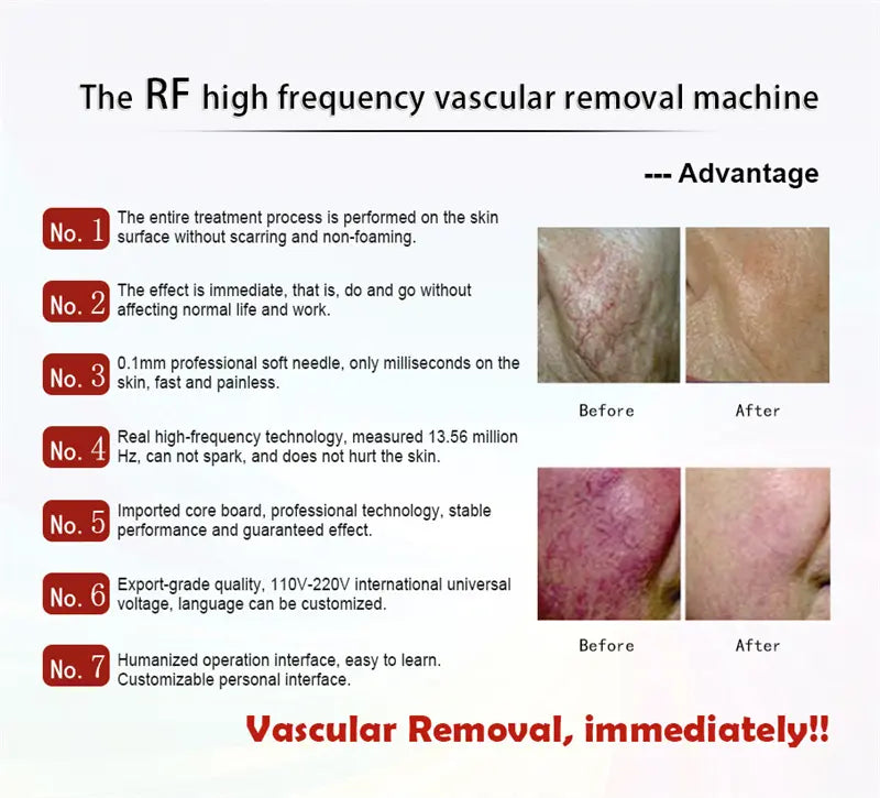 RF High Frequency Vascular Removal Machine