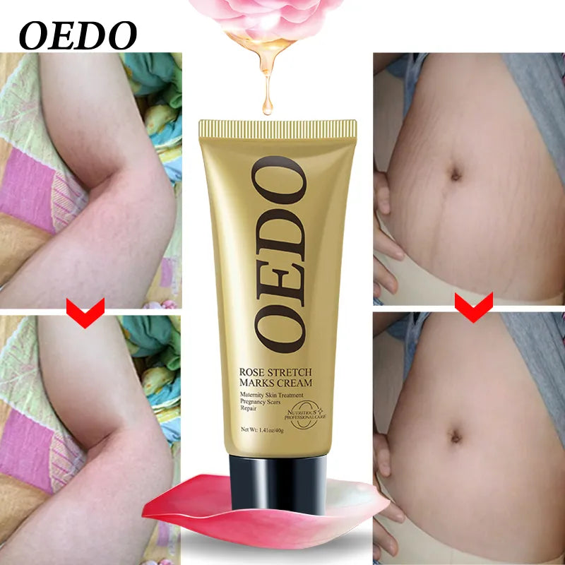 OEDO Rose Stretch Mark Cream