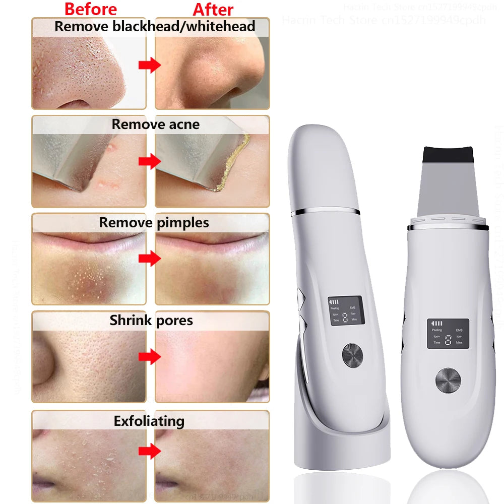 Ultrasonic Skin Scrubber with Nano Sprayer