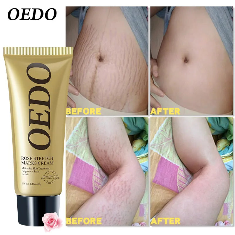 OEDO Rose Stretch Mark Cream